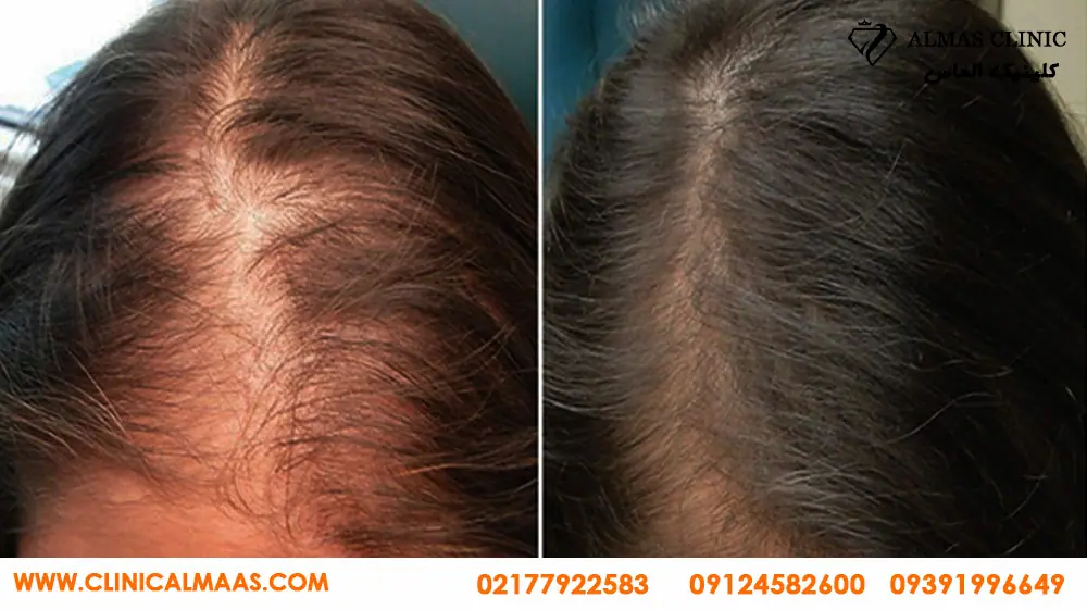 عکس قبل و بعد مزوتراپی مو