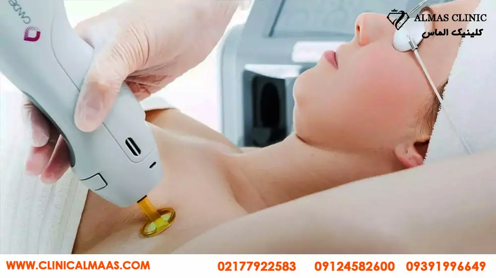 بهترین مرکز لیزر موهای زائد با دستگاه الکس کندلا در تهران 