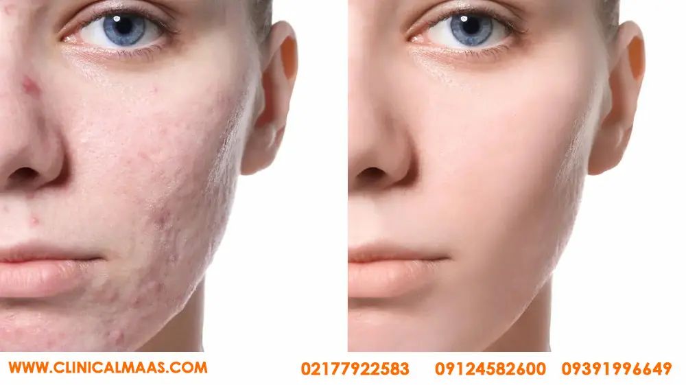 کلینیک  تخصصی مزوتراپی مو در شرق تهران