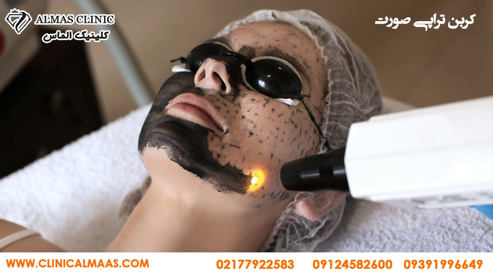 کربن تراپی صورت