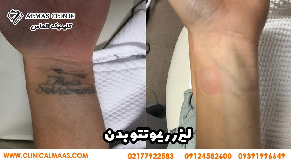 ریموو تتو