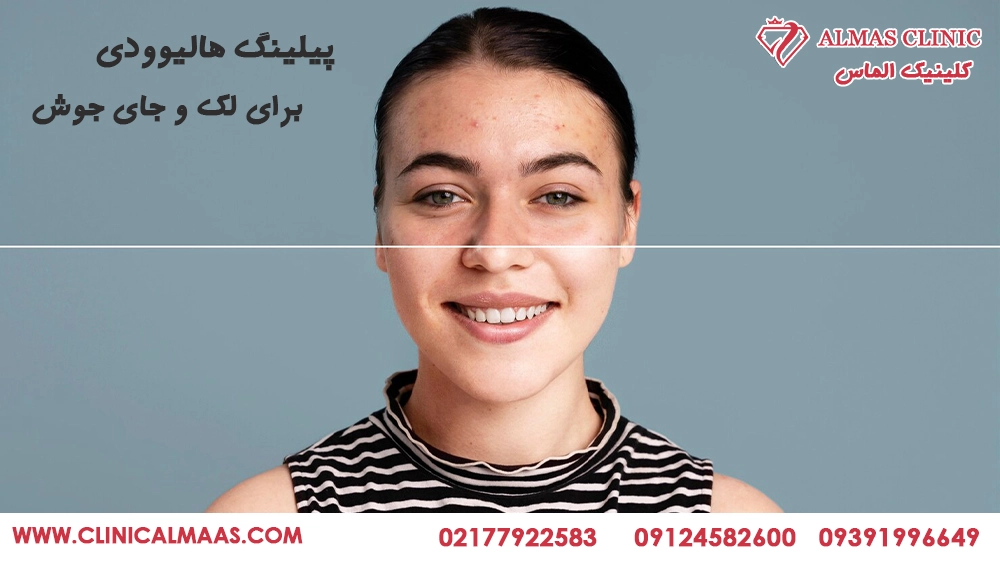 پیلینگ هالیوودی