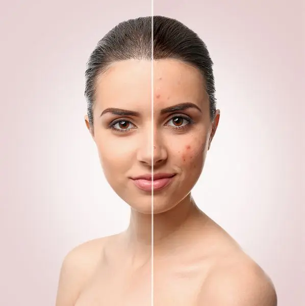 مراقبت های پس از لیزر CO2