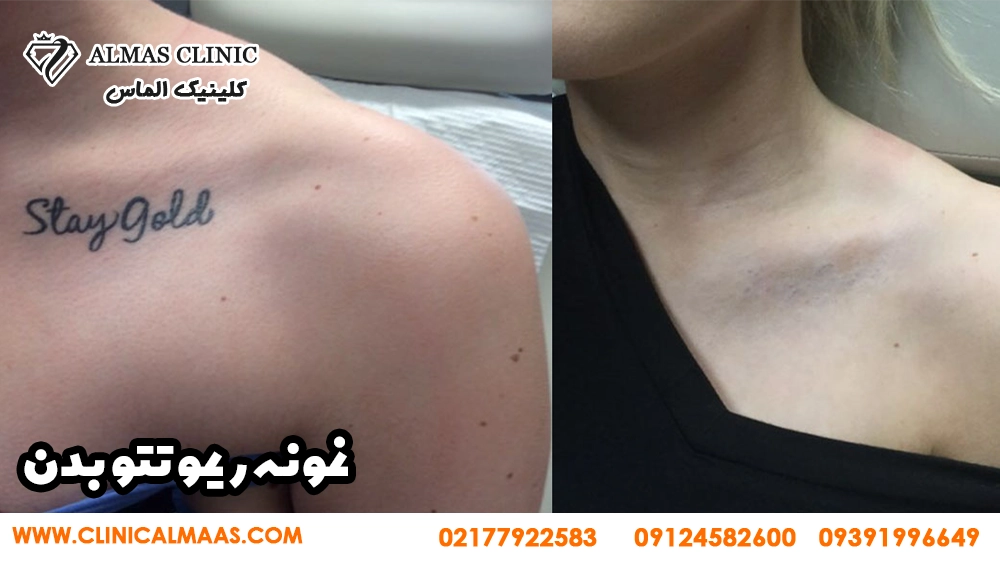 بهترین کلینیک برای ریموو تتو