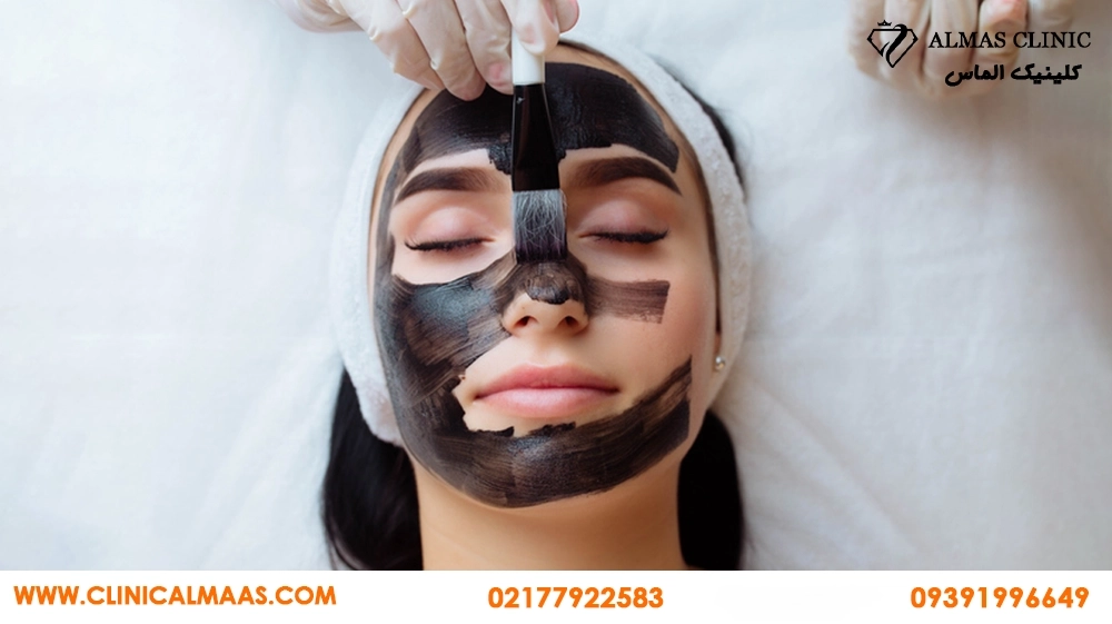 کربن تراپی برای جوش و پوست چرب؛ چند جلسه لازم است و برای چه کسانی مناسب نیست؟