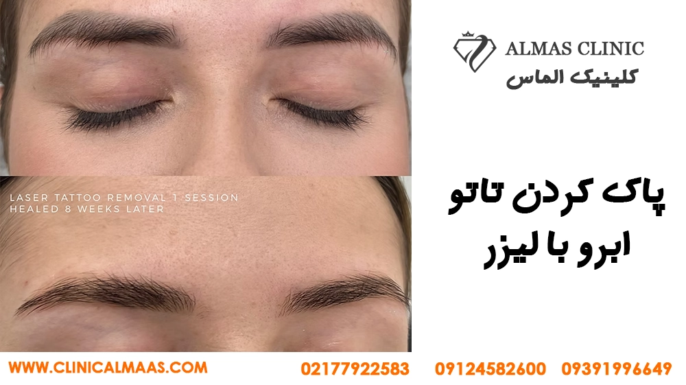 لیزر ریمو تاتو ابرو