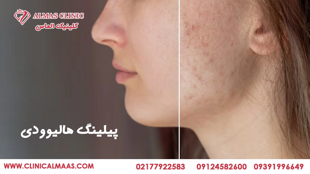 پیلینگ هالیوودی