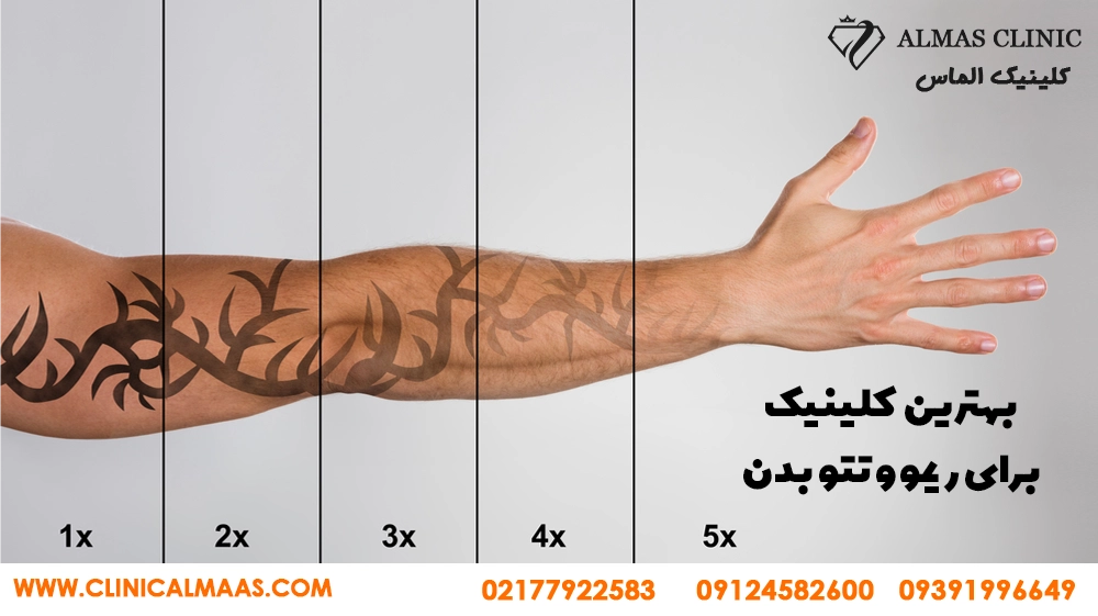بهترین مرکز ریموو تتو ابرو و بدن در تهران  قیمت و نمونه کار 1405