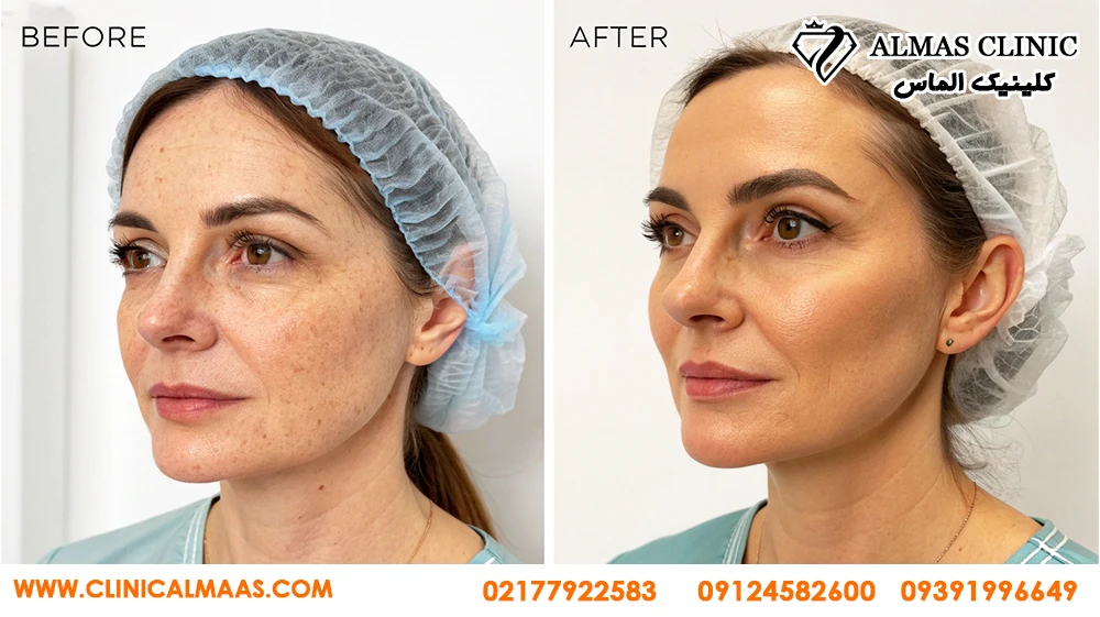 پی آر پی صورت و حجم&zwnj;دهی