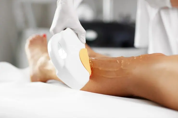 لیزر موهای زائد با کندلا در تهرانپارس