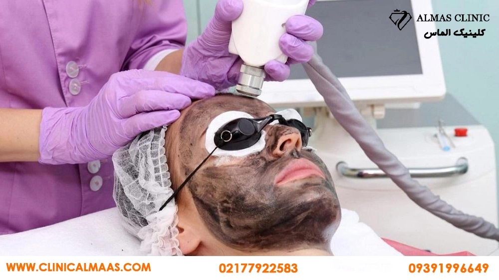 کربن تراپی برای جوش و پوست چرب؛ چند جلسه لازم است و برای چه کسانی مناسب نیست؟