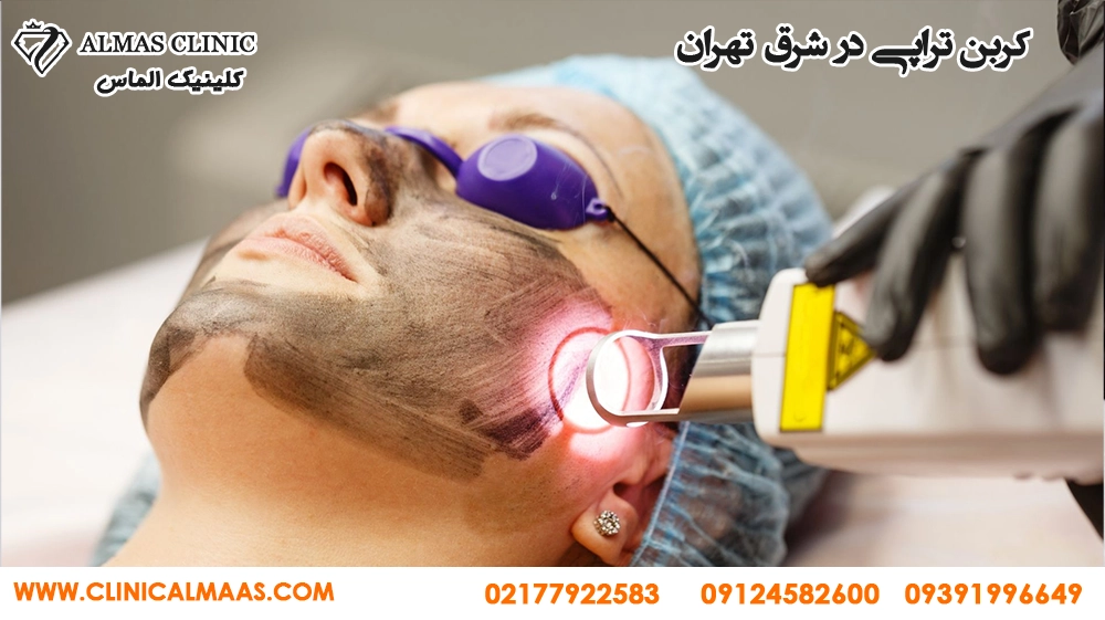 کربن تراپی صورت