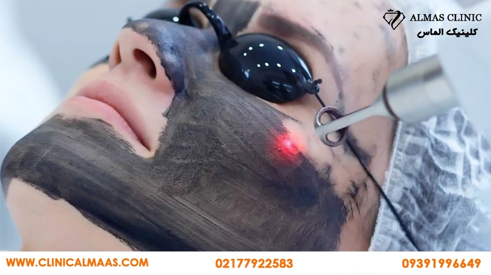 کربن تراپی برای جوش و پوست چرب؛ چند جلسه لازم است و برای چه کسانی مناسب نیست؟