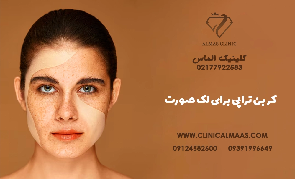 کربن تراپی برای لک صورت؛ بررسی کامل فواید، عوارض، قیمت و تعداد جلسات درمان