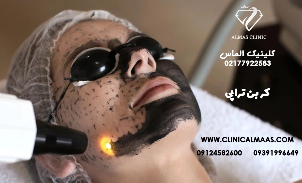 کربن تراپی 