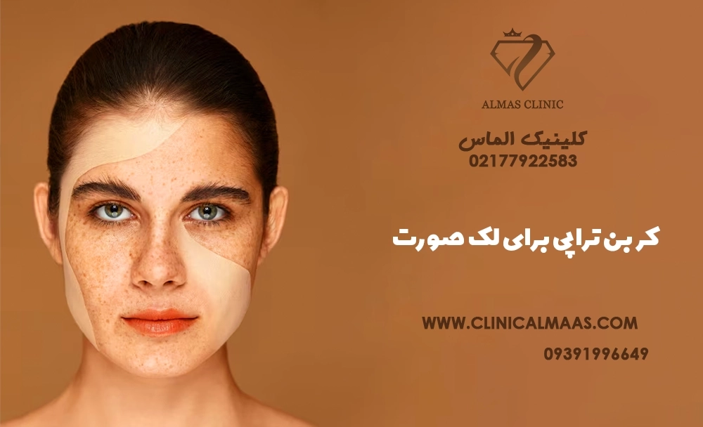 کربن تراپی برای لک صورت؛ بررسی کامل فواید، عوارض، قیمت و تعداد جلسات درمان