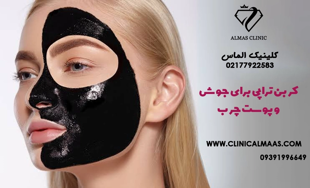 کربن تراپی برای جوش و پوست چرب؛ چند جلسه لازم است و برای چه کسانی مناسب نیست؟