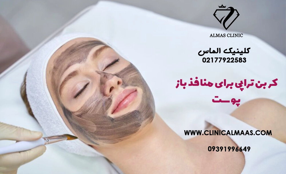 کربن تراپی برای منافذ باز پوست؛ آیا واقعاً منافذ را کوچک می‌کند؟