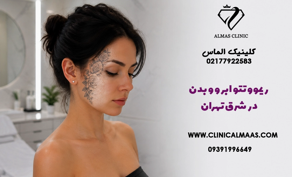 ریموو تتو ابرو و بدن در شرق تهران؛ راهنمای کامل پاک کردن تاتو با لیزر