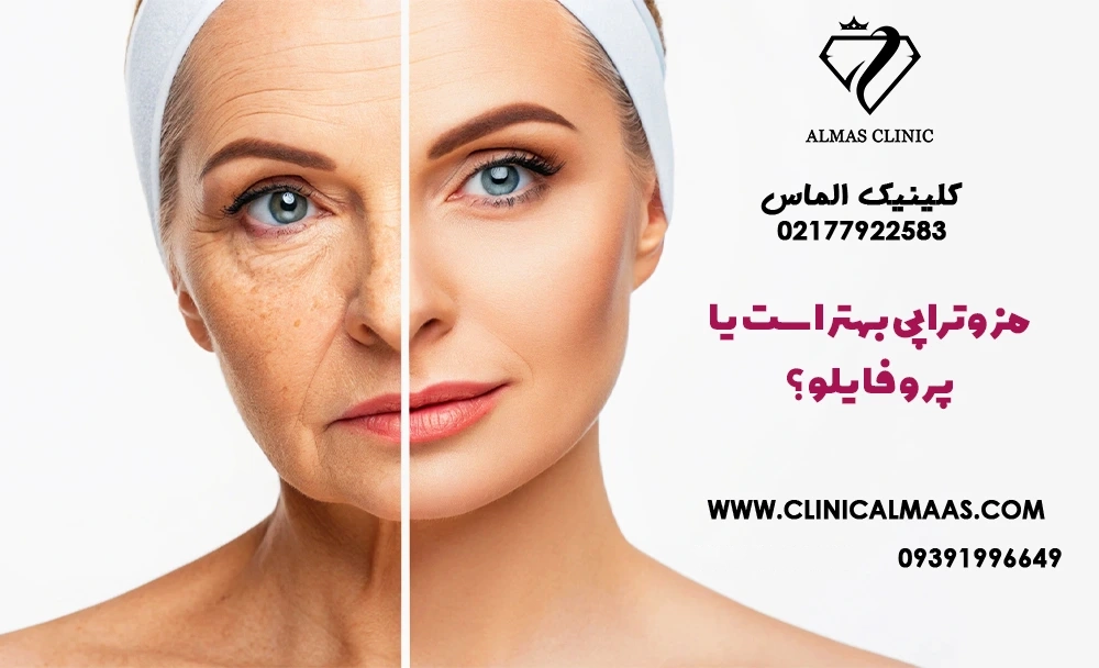 مزوتراپی بهتر است یا پروفایلو؟