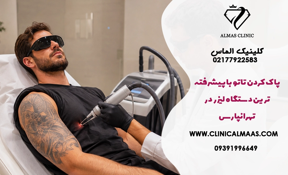 پاک کردن تاتو با پیشرفته ترین دستگاه لیزر در تهرانپارس