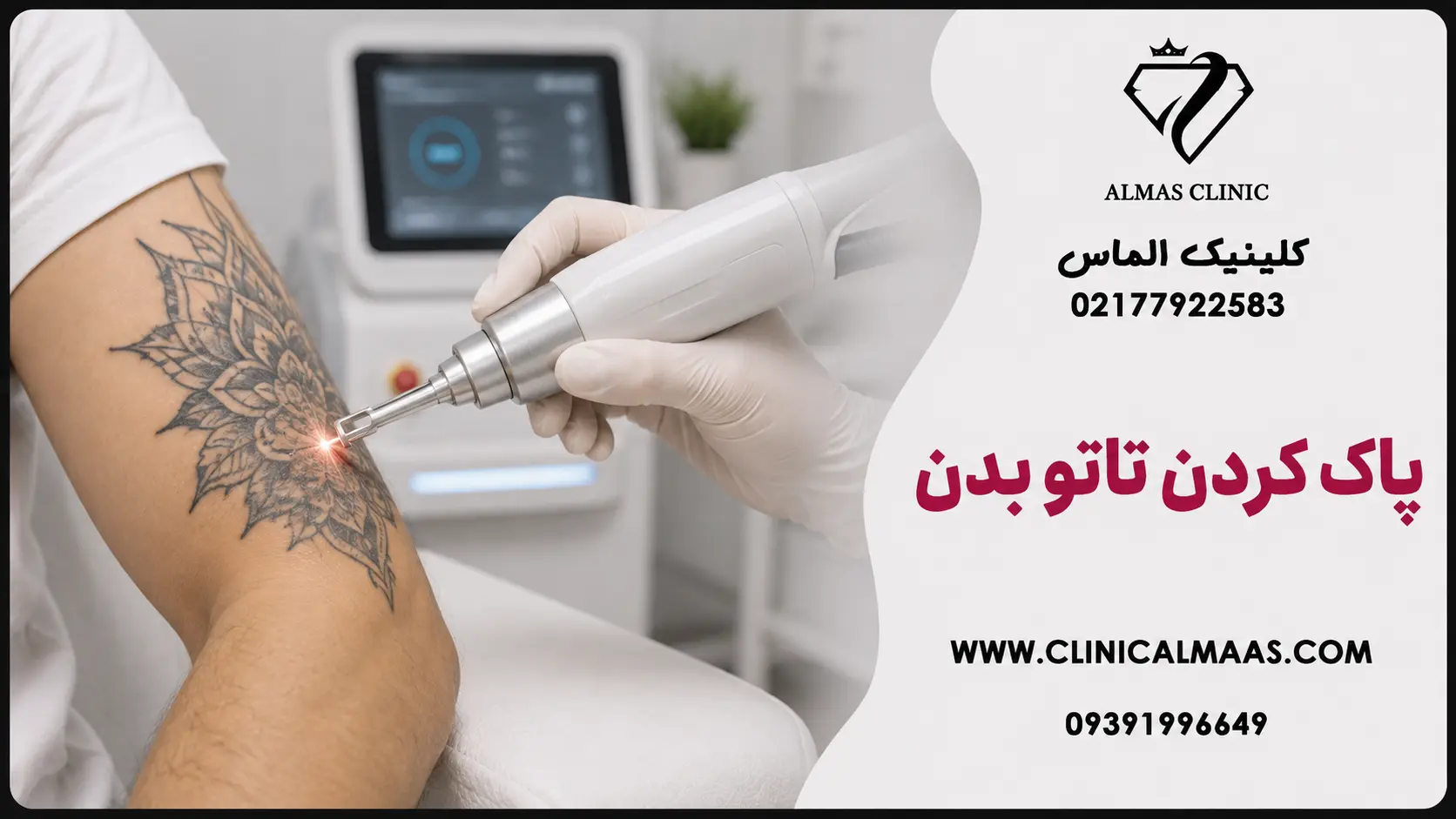 پاک کردن تاتو بدن در تهران؛ ریموو تتو با لیزر کیوسوئیچ در کلینیک الماس