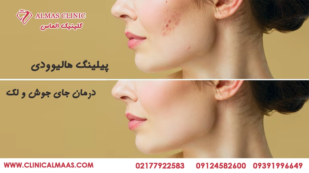 پیلینگ هالیوودی