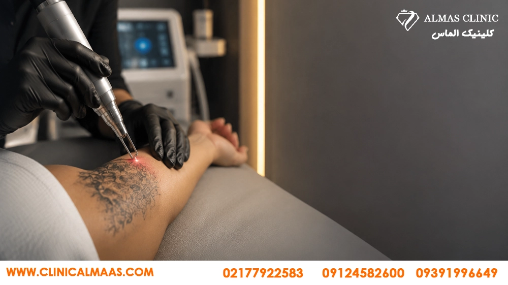 بهترین مرکز ریموو تتو در نارمک و هفت حوض؛ قبل از انتخاب کلینیک به چه نکاتی دقت کنیم؟