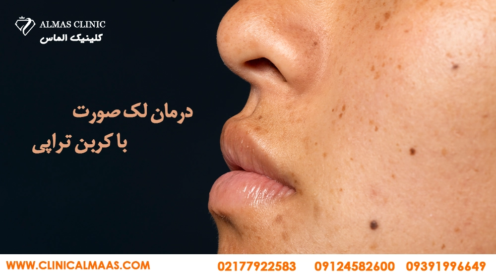 درمان-لک-صورت