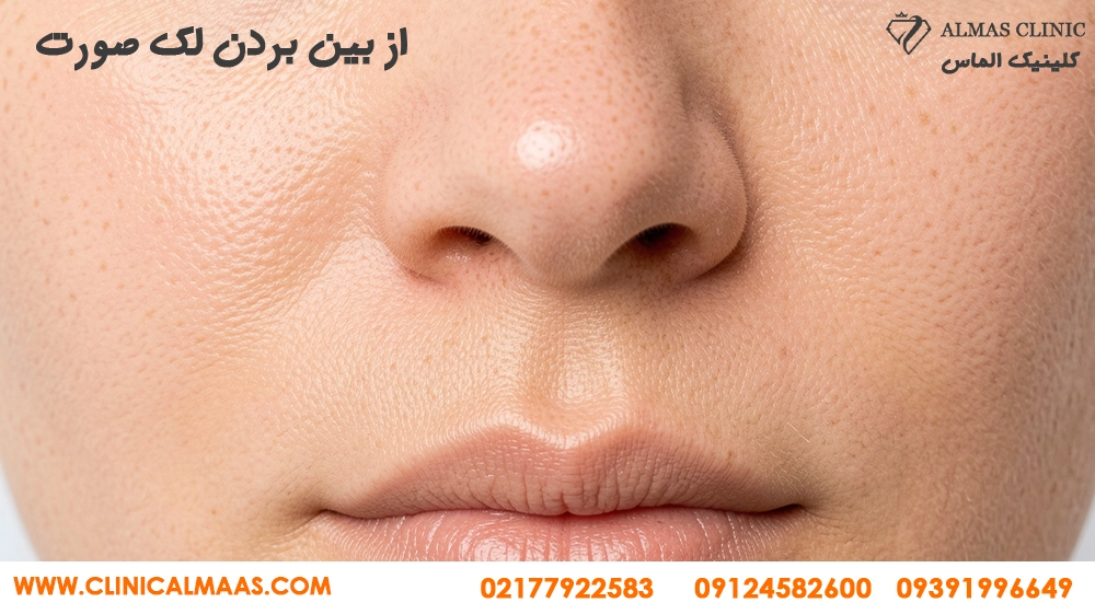 کربن تراپی برای لک صورت