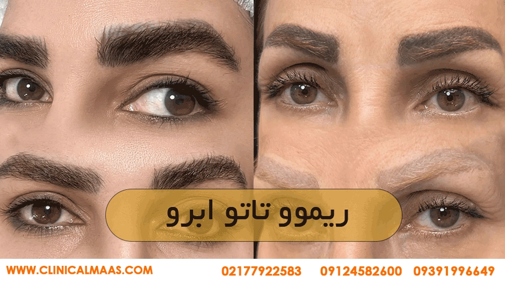 ریموو تتو ابرو و بدن | راهنمای کامل پاک کردن تاتو با لیزر