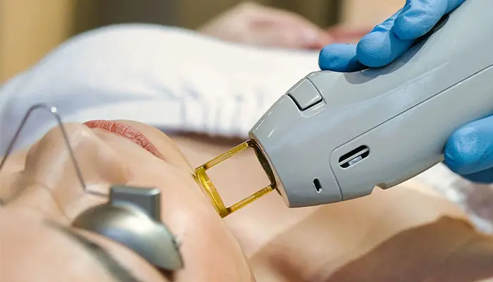 لیزر موی صورت با کندلا